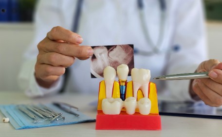 Dental Implant: How Long Does It Last And What Affects Its Lifespan